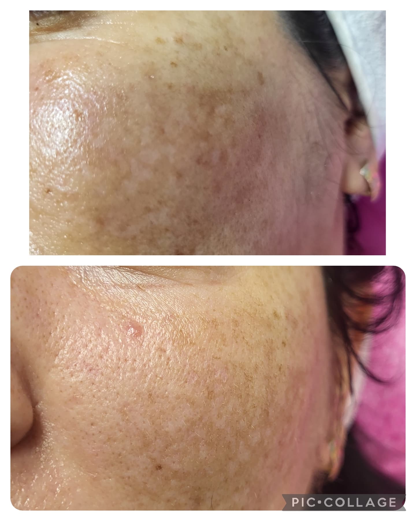 Химичен пилинг