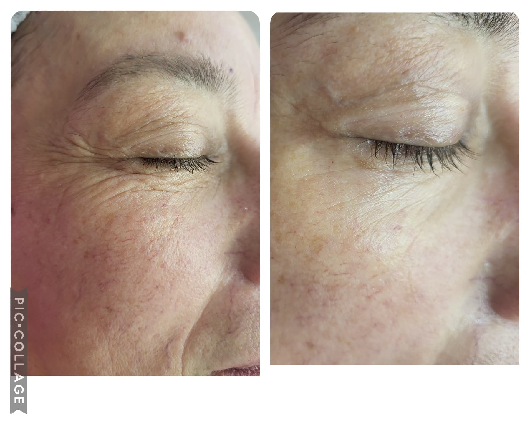 Антиейж процедури