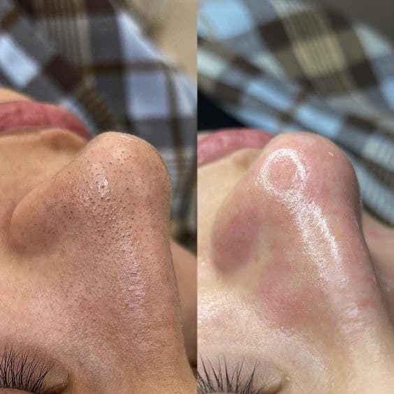 Facial cleansing with manual comedone extraction