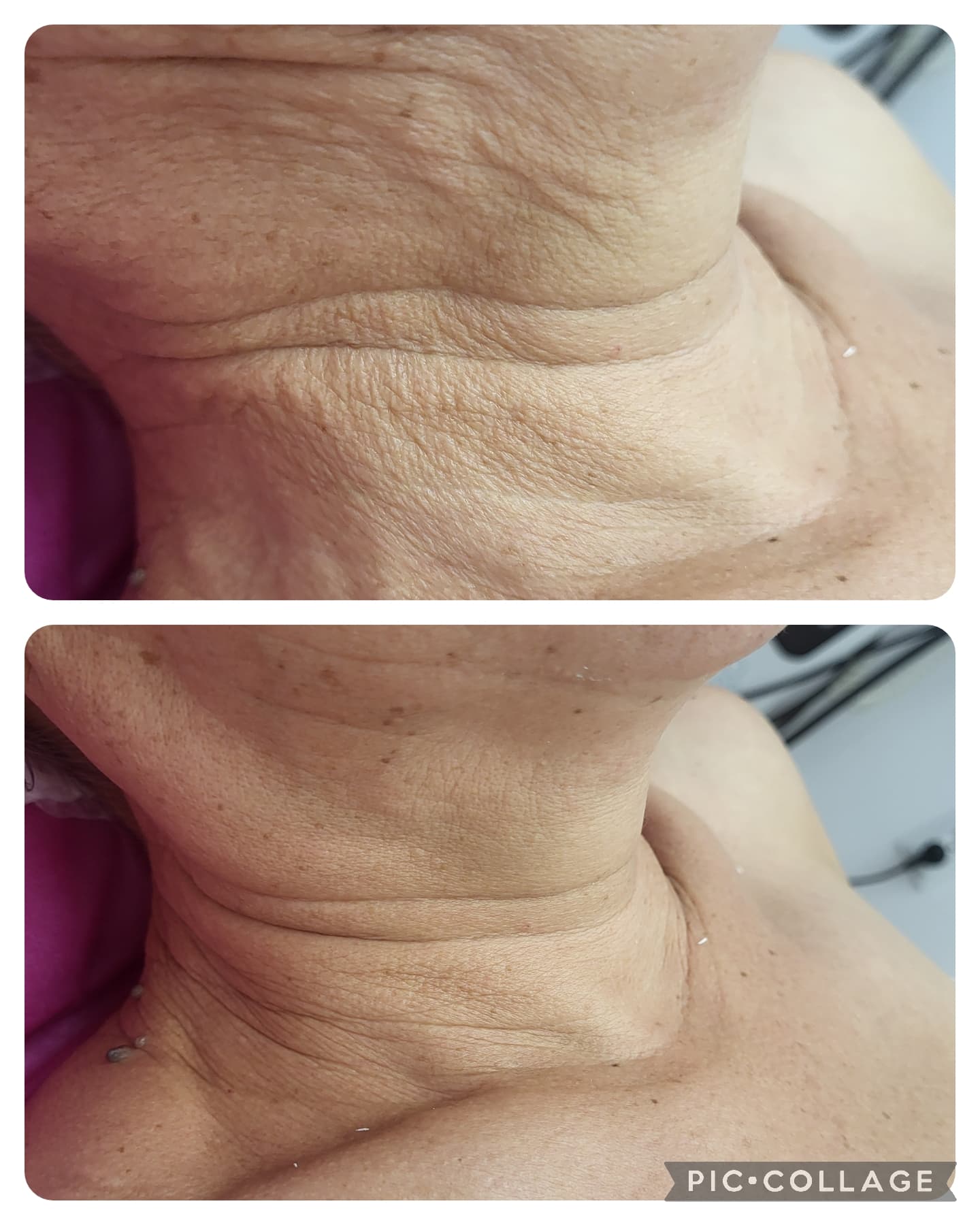 Мезотерапия