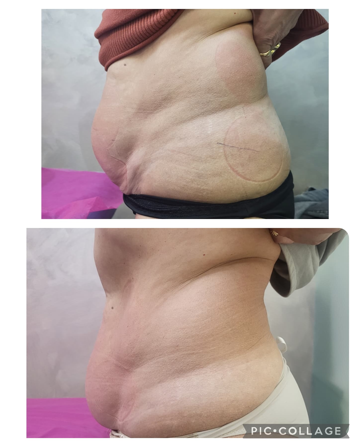 TERMAFIT антитицелулитна процедура